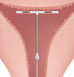 A diagram showing Paragard inside the uterus